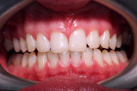 Зубы после отбеливания